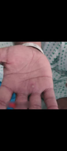 菲律宾卫生部周一表示，该国首例猴痘病例已经康复。