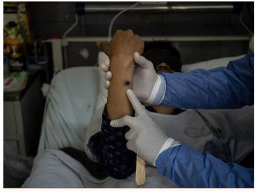 注意！菲律宾再现2例猴痘确诊病例，至少17名密接者！